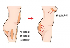 自体脂肪丰胸的副作用和危害？自体脂肪丰胸恢复期有多久？