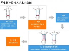 玻尿酸男性增大注射能保持多久？玻尿酸男性增大注射有风险吗？