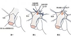 增长增粗手术需要多少钱？更多科普知识已经收集