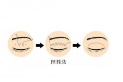 割双眼皮有什么危害或者后遗症？分享双眼皮的方式方面